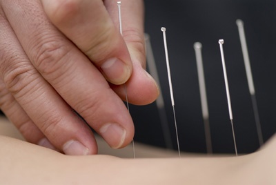 Tratament acupunctura