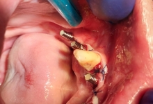 Medic Bun Campulung Muscel Endodontie Campulung Muscel - Clinica Dr. Gupta
