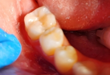 Medic Bun Curtea de Arges Endodontie Curtea de Arges - Clinica Dr. Gupta