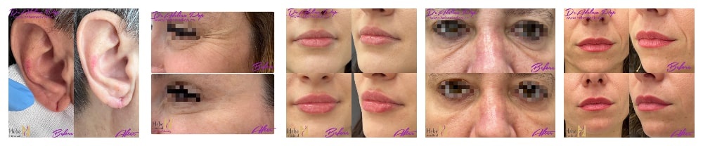 botox riduri marire buze targu mures botox riduri marire buze targu mures